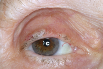 Pre-op right upper eyelid sebaceous cell carcinoma