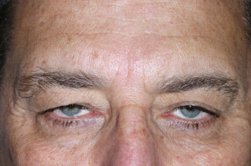 Male pre-op ptosis and blepharoplasty with excess upper eyelid skin and drooping eyelids