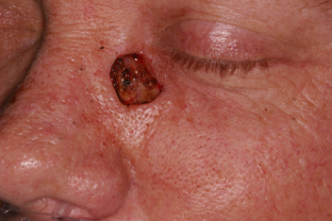 Left nasal Mohs' defect