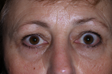 Left Upper Eyelid Retraction, pre-op