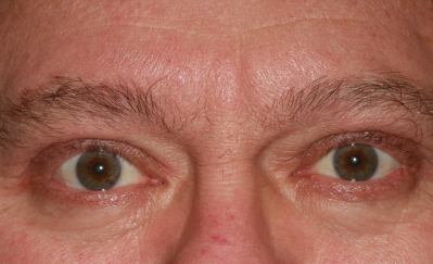 Male post-op ptosis and blepharoplasty with improved eyelid height and reduced eyelid fullness