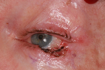 Left lower eyelid Mohs' defect