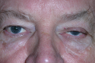 Male pre-op ptosis repair with drooping left eyelid