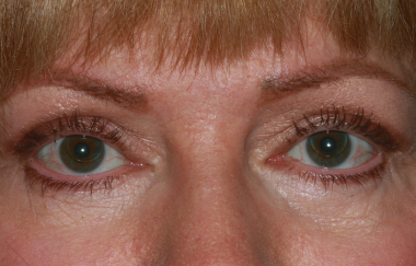 Female post-op ptosis and blepharoplasty improved eyelid height and symmetry