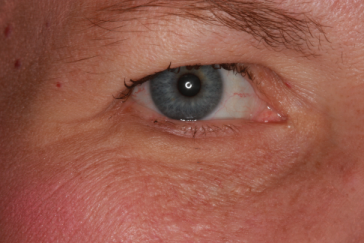 Post-op 3 months right lower eyelid reconstruction