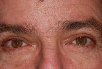 Male post-op brow lift with improved brow position