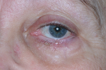 Post-op 3 months left lower eyelid reconstruction