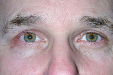 Post-op 6 weeks right upper eyelid reconstruction