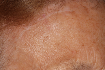 Right Side Pretrichial Scar