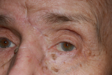 Post-op 9 months after glabella flap left