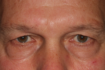 Male pre-op brow lift and blepharoplasty with heavy brows and lids