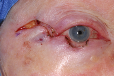 Intraoperative photograph right lower eyelid semicircular flap