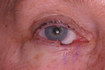 Right lower eyelid Mohs' defect