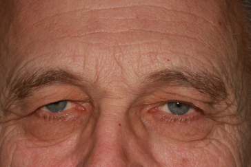 Male pre-op brow lift with brow descent