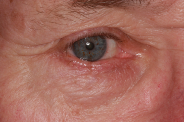 Post-op 4 months right lower eyelid reconstruction