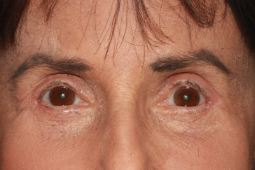 Female post-op ptosis and upper and lower blepharoplasty with improved eyelid height and less puffiness