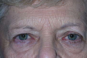 Female pre-op ptosis and blepharoplasty with drooping upper eyelids and excess upper eyelid skin
