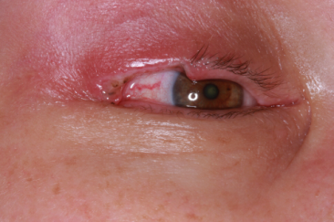 Intraoperative photograph, right sebaceous cell carcinoma wide excision