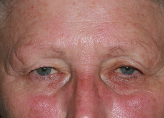 Female pre-op blepharoplasty and brow lift with excess upper eyelid skin and brow descent