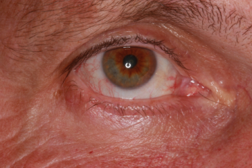 Post-op 2 months right lower eyelid