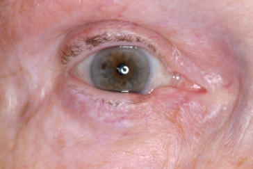 Pre-op basal cell carcinoma right lower eyelid