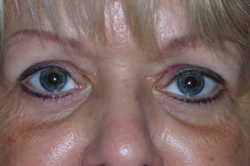 Female post-op ptosis and blepharoplasty with improved eyelid position