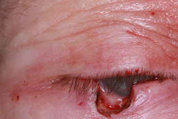 Right lower eyelid Mohs' defect