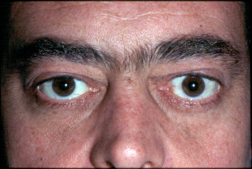 Bilateral Lower Eyelid Retraction, pre-op