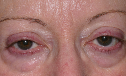 Female pre-op ptosis and lower blepharoplasty with drooping eyelids and lower eyelid fullness