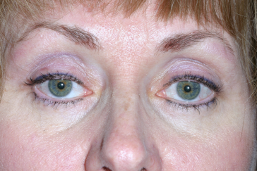After Retraction Repair right upper eyelid