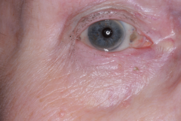 Post-op 3 months after repair right lower eyelid