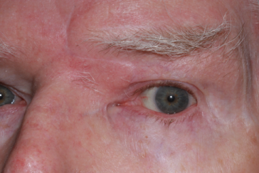 Post-op 3 months post glabellar flap left upper eyelid