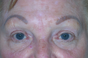 Female post-op ptosis and blepharoplasty with improved eyelid height