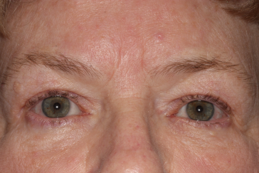 Female post-op blepharoplasty and brow lift with improved lid and brow position