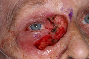 Intra-operative photograph medial canthus Mohs' defect