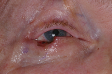 Right lower eyelid Mohs' defect