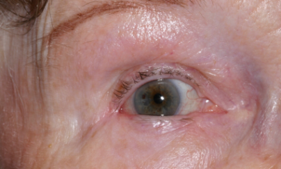 Post-op 2 months after wedge repair right lower eyelid