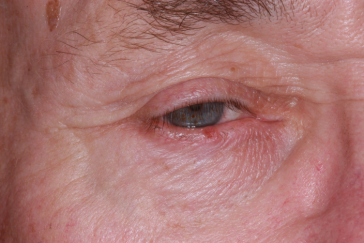 Pre-op right lower eyelid squamous cell carcinoma