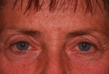 Female pre-op blepharoplasty and brow lift with brow descent and excess upper eyelid skin