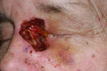 Left medial canthus Mohs' defect