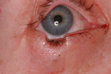 Right lower eyelid Mohs' defect