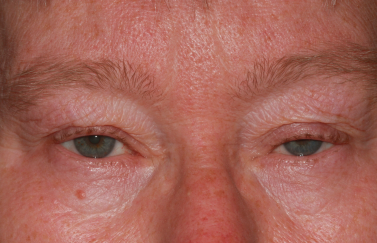 Female pre-op ptosis and blepharoplasty with drooping eyelids and excess skin