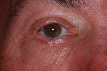 Post-op 3 months right lower eyelid reconstruction