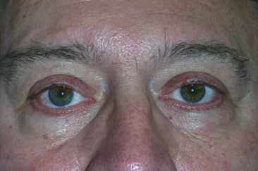 Male post-op ptosis repair with improved eyelid height