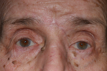 Post-op left upper eyelid reconstruction