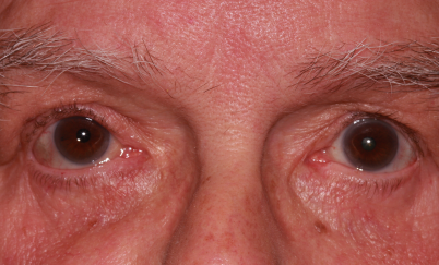 Male post-op ptosis and blepharoplasty with improved eyelid height and reduced eyelid fullness
