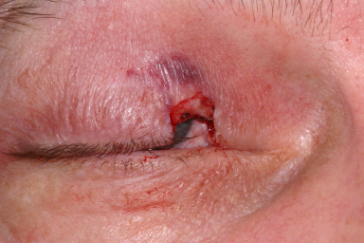 Right upper eyelid wedge defect