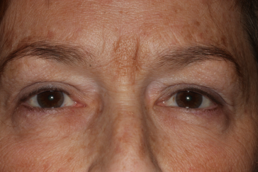 Female post-op blepharoplasty and brow lift with improved lid and brow position