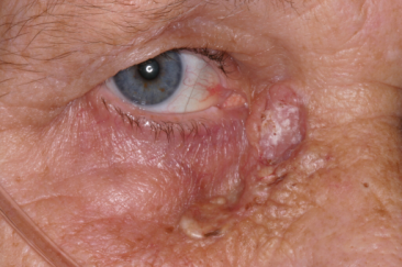 Large basal cell carcinoma right lower eyelid
