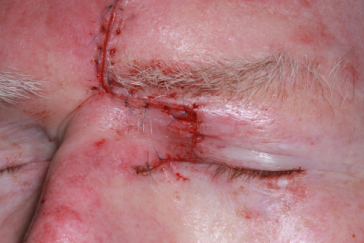 Intraoperative photograph left glabellar flap
